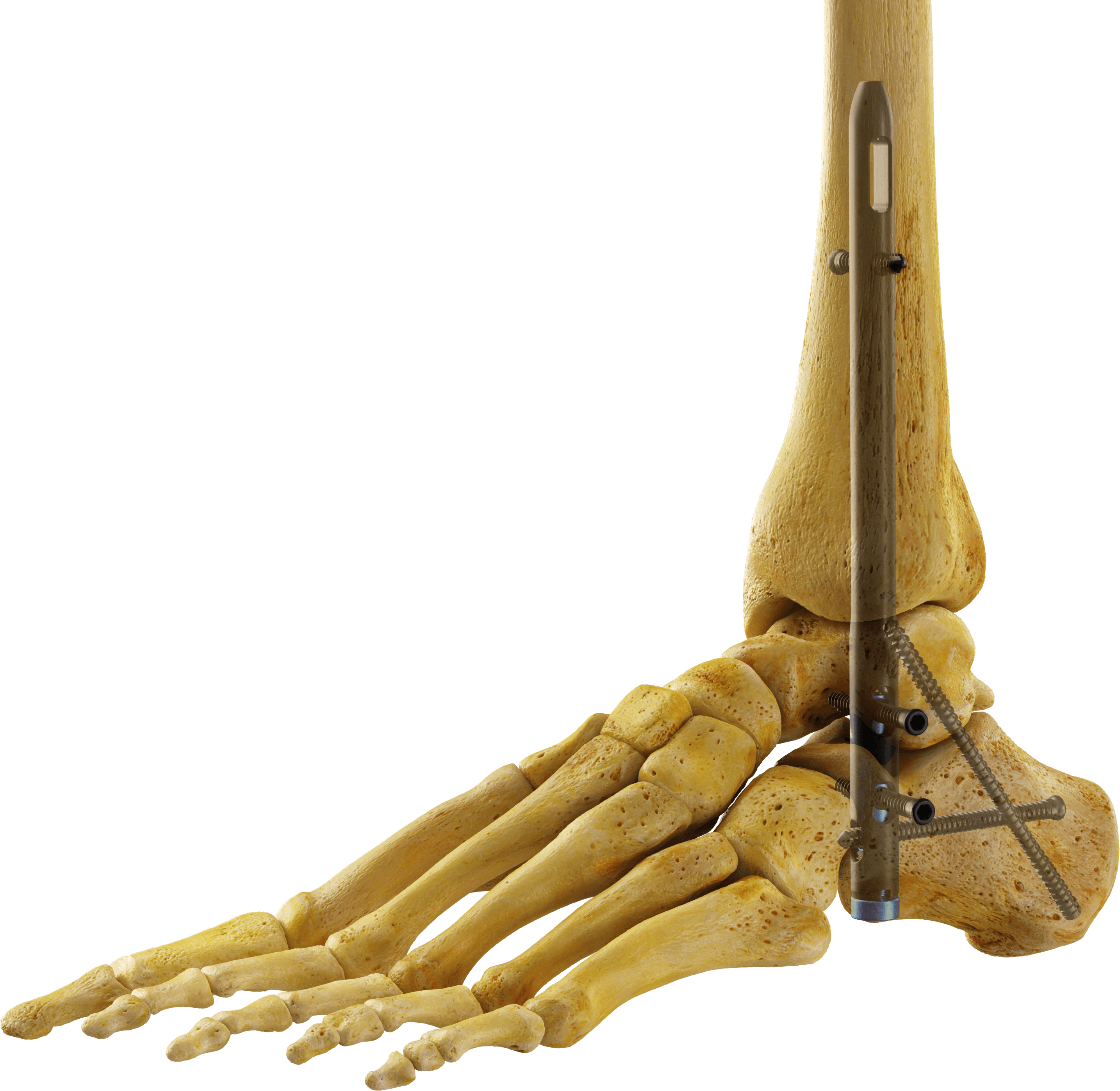Duo Hindfoot Nail
