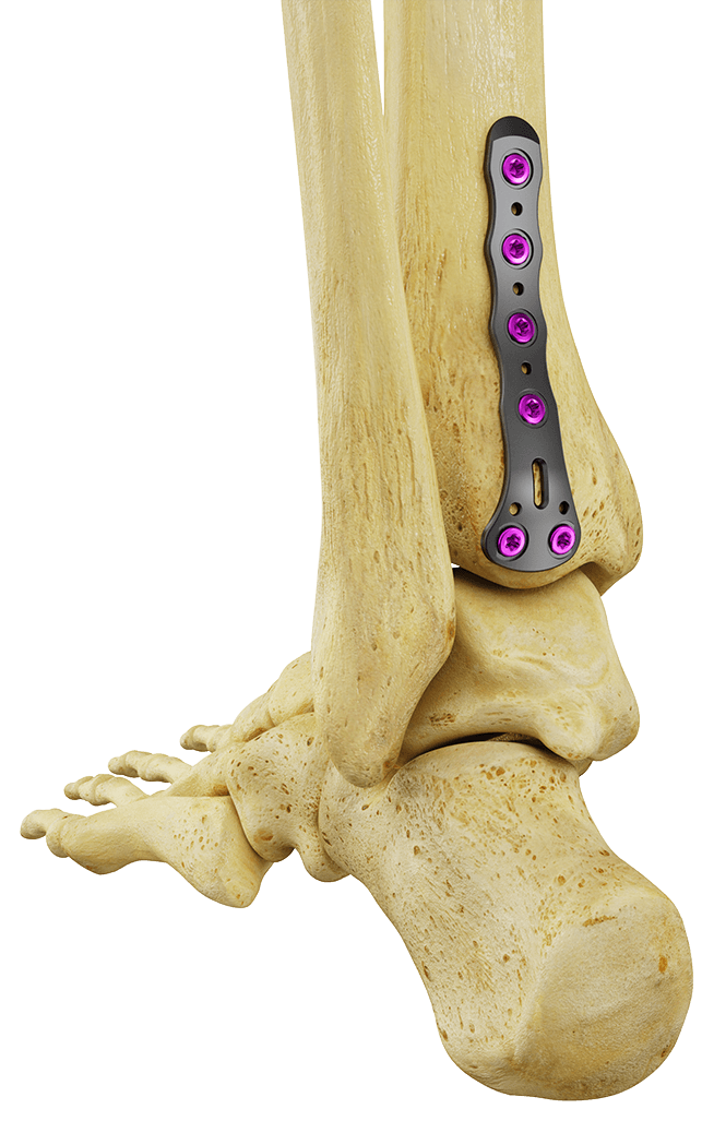 AnkleFX Plating